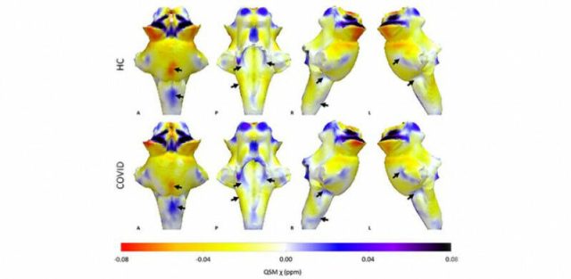 Projeções 3D de mapas QSM no tronco cerebral renderizado Crédito: Universidade de Cambr