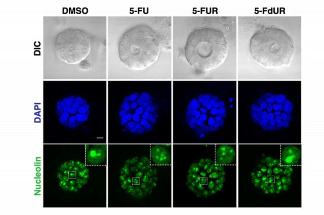 Nestas imagens, os tumores que se beneficiam clinicamente do tratamento com 5-fluorouracil (5-FU)