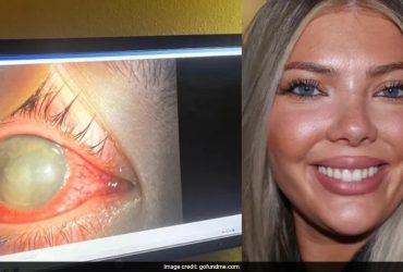 US Woman, 23, Goes Blind In One Eye After Swimming With Contact Lenses