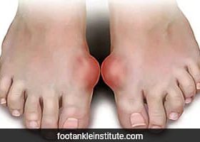 Study Uncovers Major Causes of Gout, Debunking Common Myths